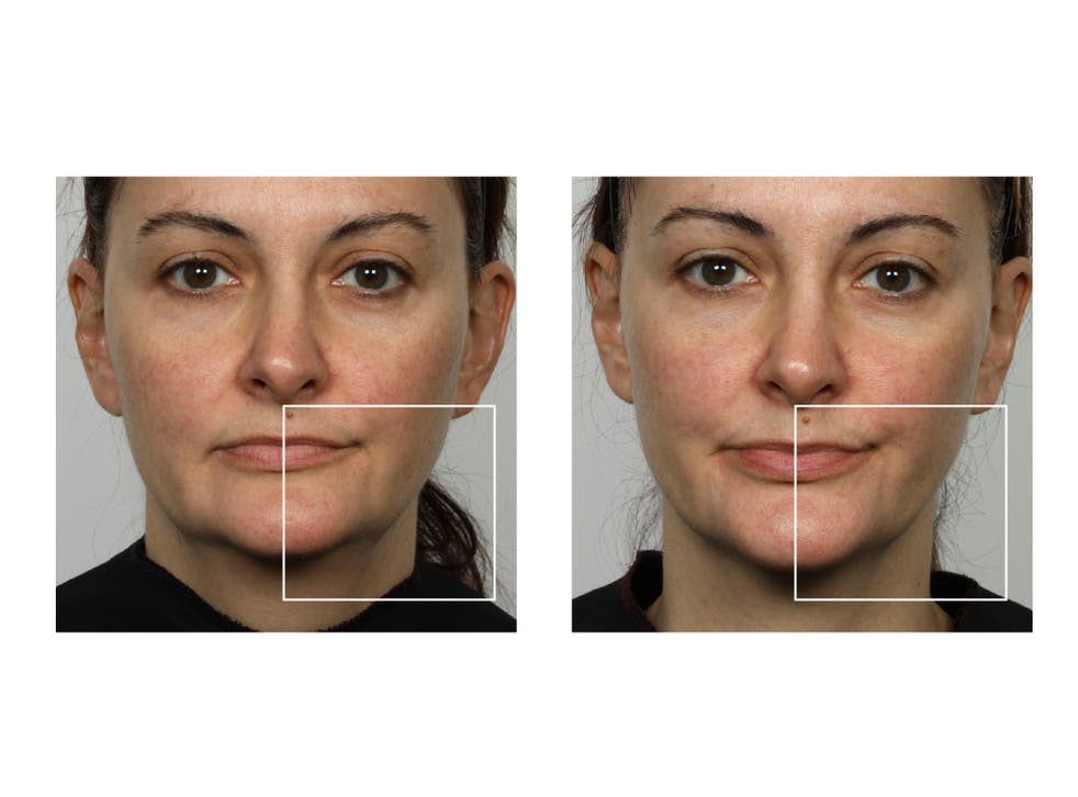 <p>Before and after results using the NuFACE Mini device</s>