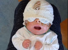 Baby born with thick ‘turtle shell’ skin defies medics’ expectations for her survival