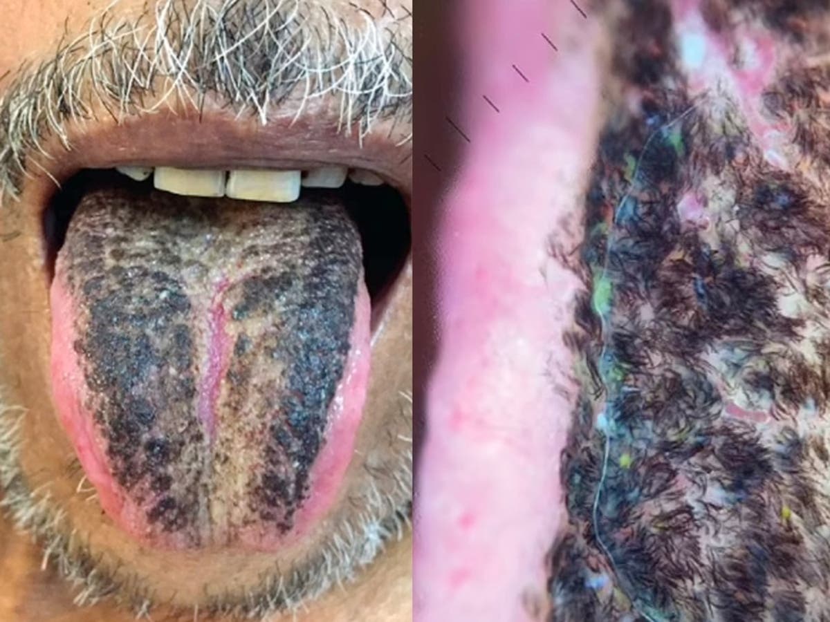 Man’s tongue turns black and ‘hairy’ after suffering stroke