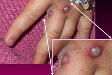 varíola: Seven symptoms of virus confirmed in UK