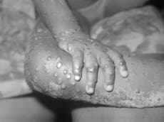 UK monkeypox outbreak ‘unprecedented’ as officials say sexual contact likely route of transmission
