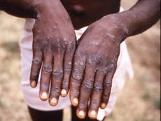  Monkeypox symptoms: What to look for