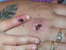 Eleven new monkeypox cases in UK as outbreak spreads