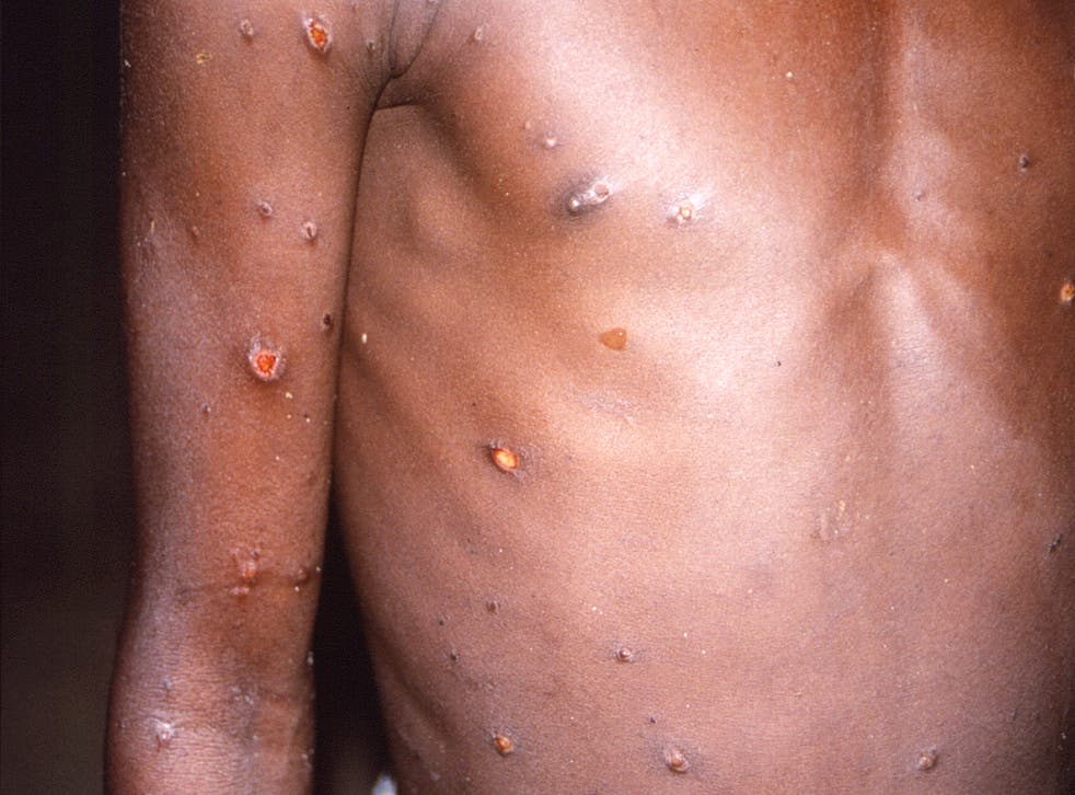 <p>The right arm and torso of a patient with lesions due to monkeypox </bl>