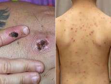 What is the difference between monkeypox and chickenpox?