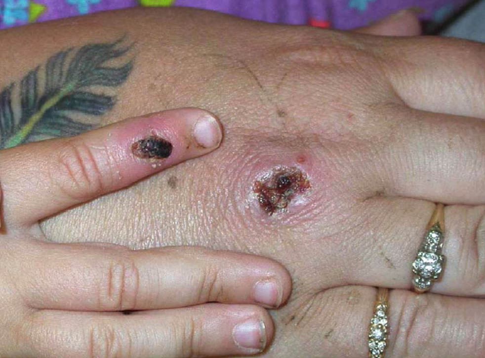 <p>Monkeypox cases cause a rash on the skin which evolve from lesions into blisters </磷>