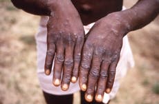 First cases of monkeypox confirmed in South Korea and Singapore