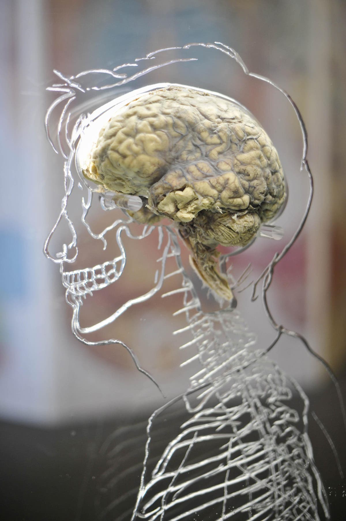 Single brain scan could diagnose Alzheimer’s disease, studie antyder