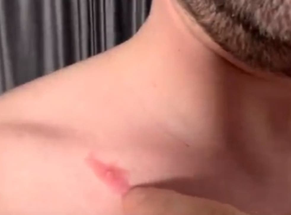 <p>Maxim Sapozhnikov has shown pimple-like marks on his body to his Instagram followers</磷>