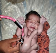 4本の腕と4本の足で生まれた赤ちゃんは「神の生まれ変わり」を歓迎しました