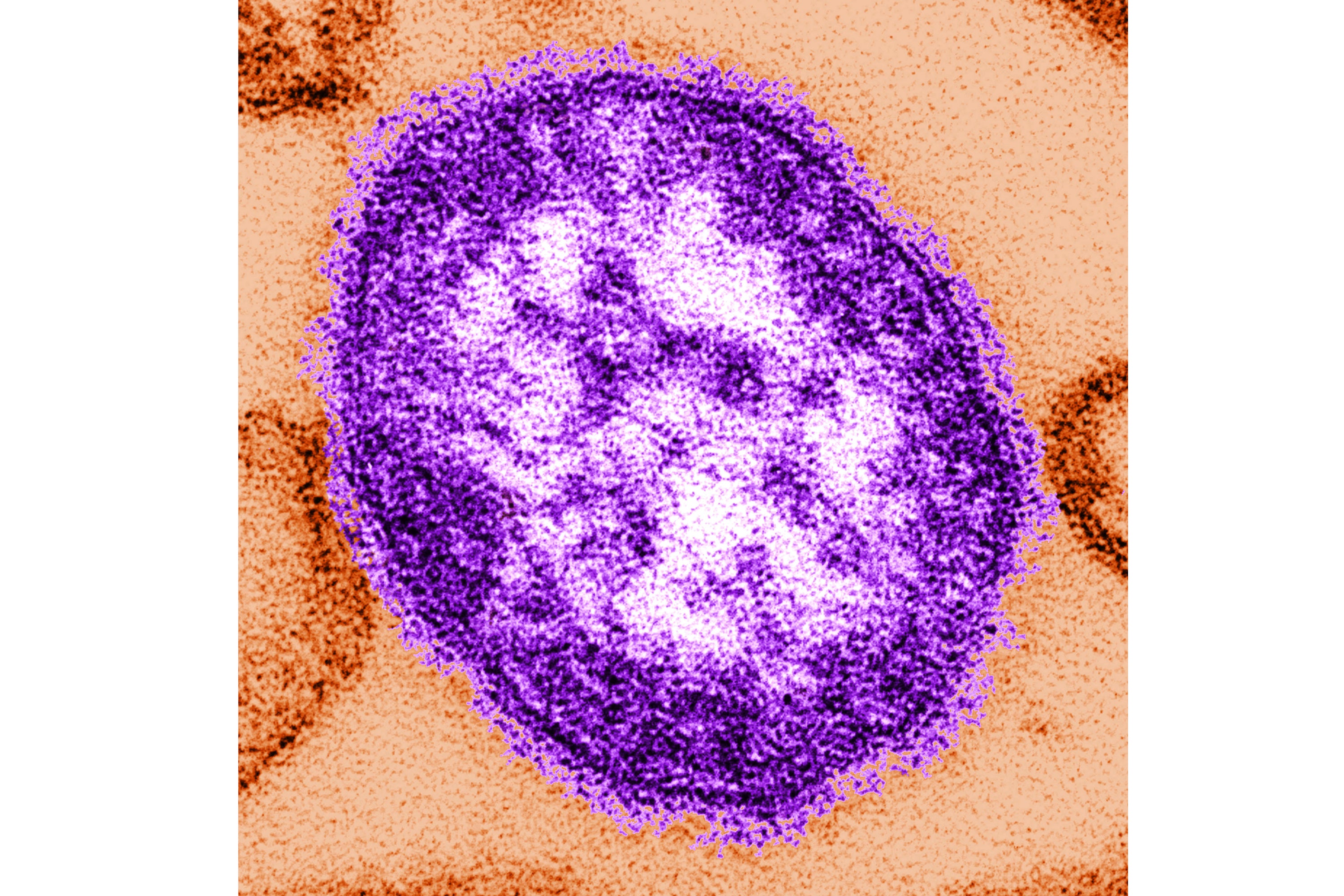 Pennsylvania health officials announced two measles-related deaths this week, the state’s first in 35 years