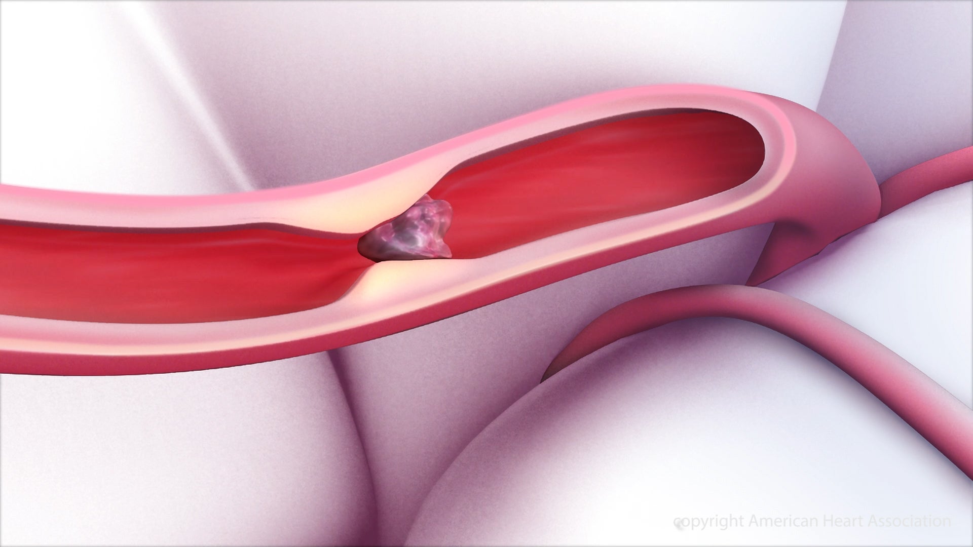 A stroke is typically caused by a clot that disrupts blood flow the the brain, as seen in this illustrative image from the American Heart Association