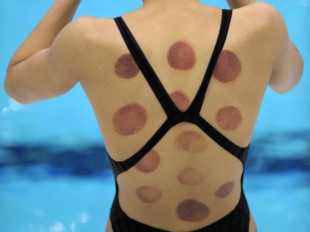 cupping-olympics.jpg