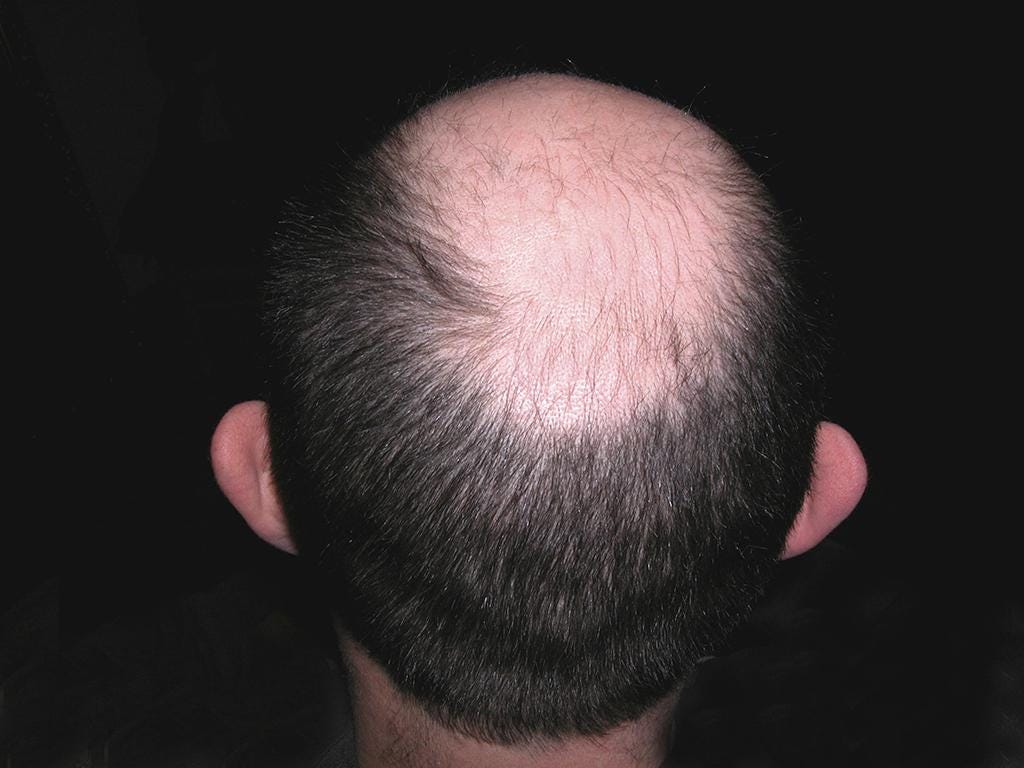 Hair Loss Explained How And Why Men Go Bald Health And Families Lifestyle The Independent 8920