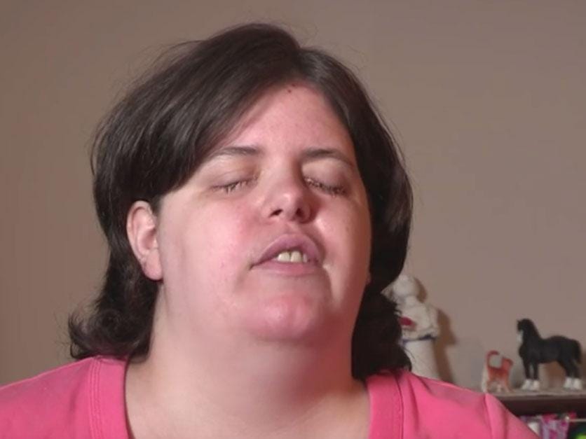 Jewel Shuping from North Carolina is diagnosed Body Integrity Identity Disorder