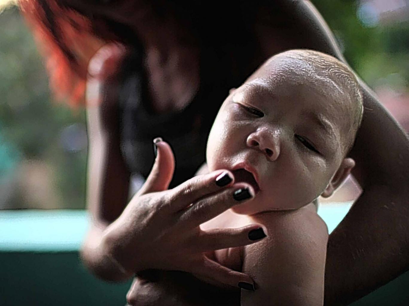 Bite fright: Zika virus may be responsible for a rise in infant microcephaly