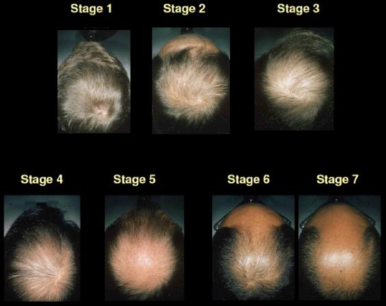 Hair Loss Explained How And Why Men Go Bald The Independent 8630