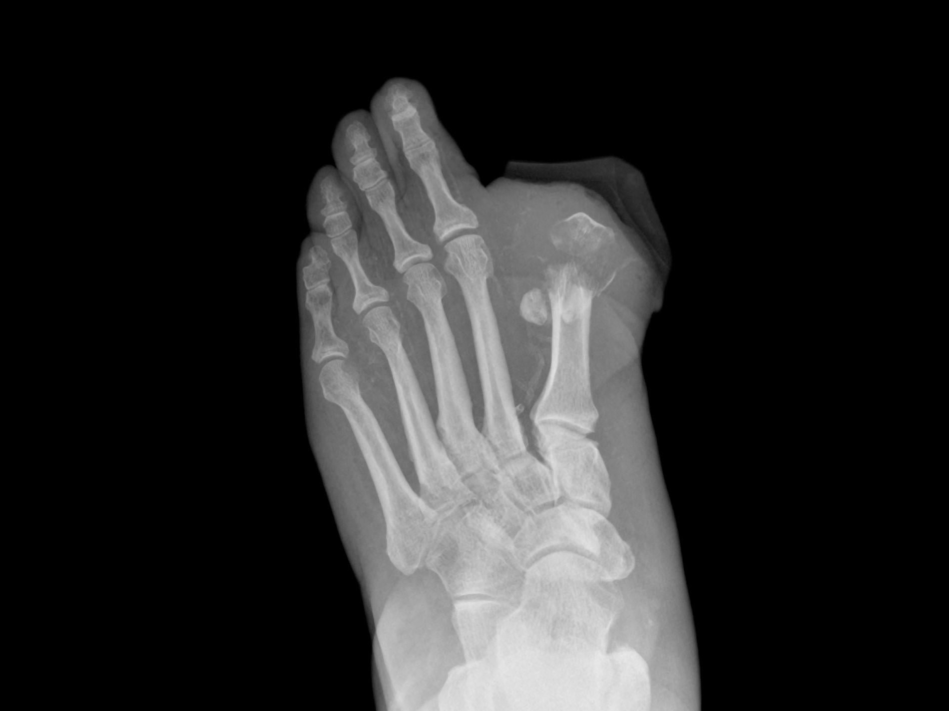 Остеомиелит пальцев стопы рентген
