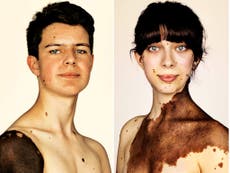 People with rare skin condition challenge 'conventional perceptions of beauty' in photography exhibition