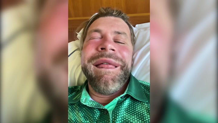 Brian McFadden shares allergic facial reaction to bee sting