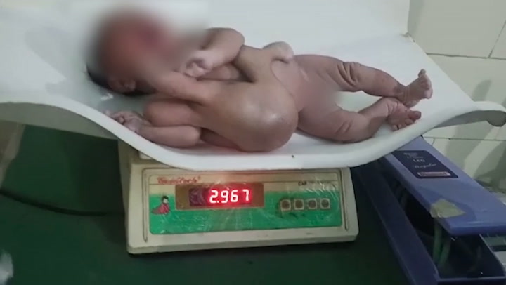 Baby born with four extra limbs believed to be Hindu goddess reincarnation