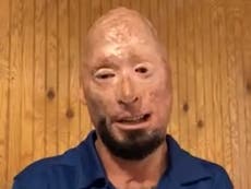 Injured army veteran pushes back after his image is used in anti-Trump ‘propaganda’