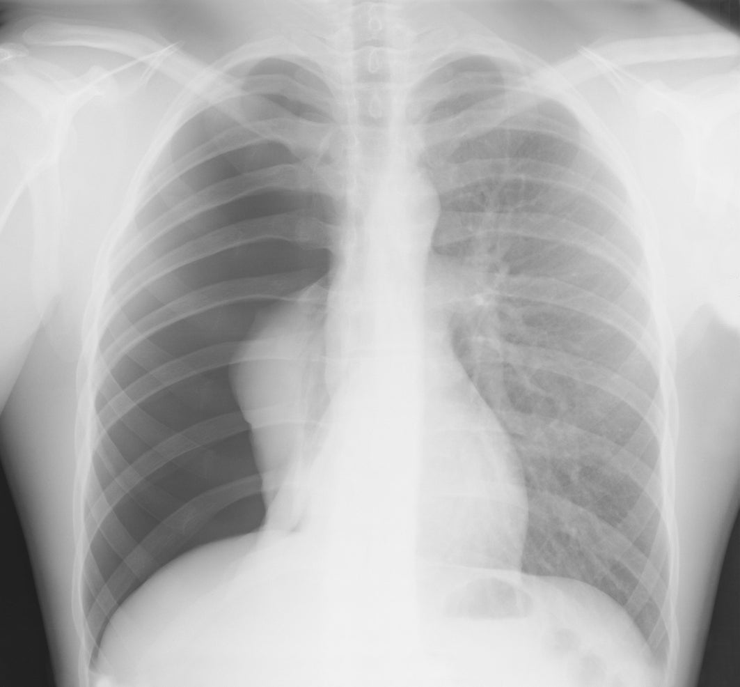 Collapsed lungs are another dangerous complication caused by the Covid-19 virus