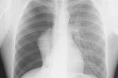 Coronavirus patients at increased risk of collapsed lung, study finds