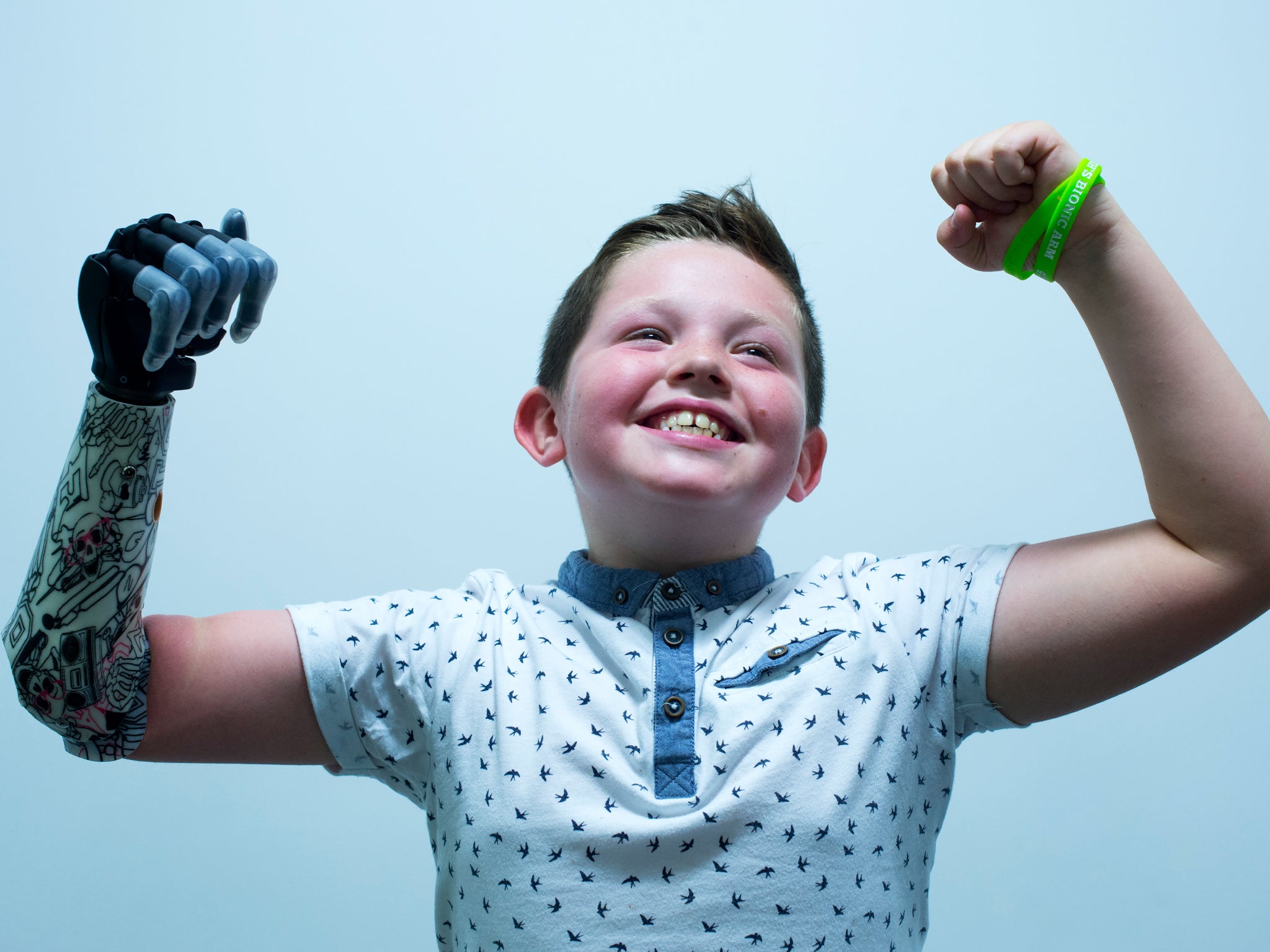 Nine year old Josh Cathcart, who was born with his right arm missing, became the first person in the UK to receive a bionic advanced prosthetic device in 2015