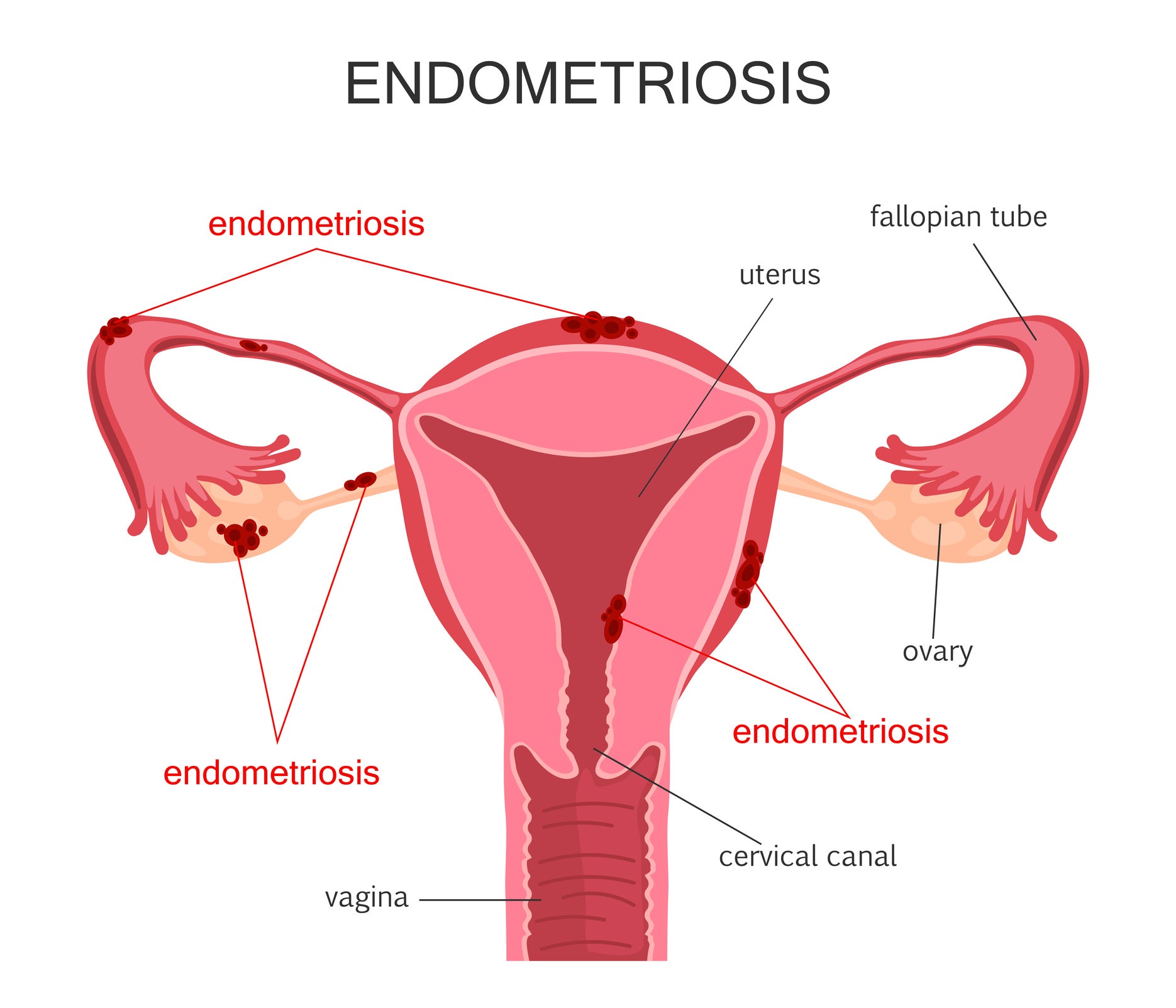 A diagram indicating cysts caused by endometriosis