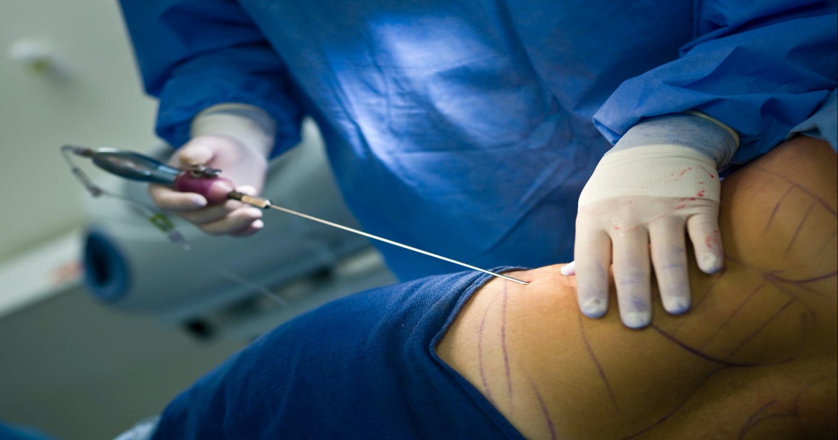 Woman dies after Brazilian butt lift surgery in Miami | The Independent