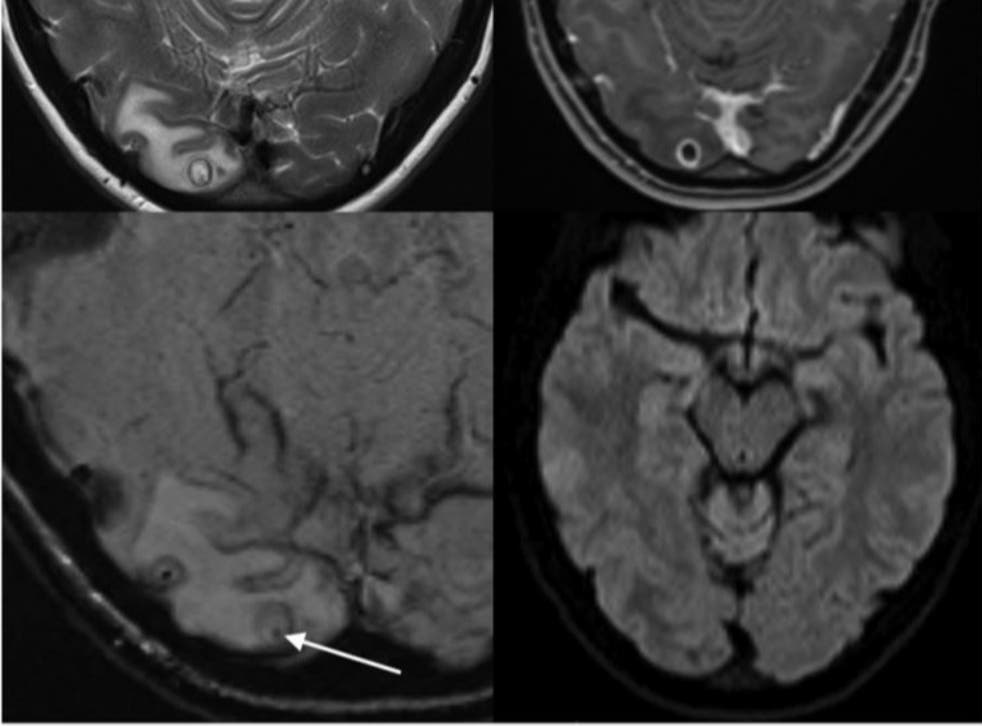 Imagen de resonancia magnética que muestra lo que parecía ser una lesión quística en el lóbulo occipital derecho