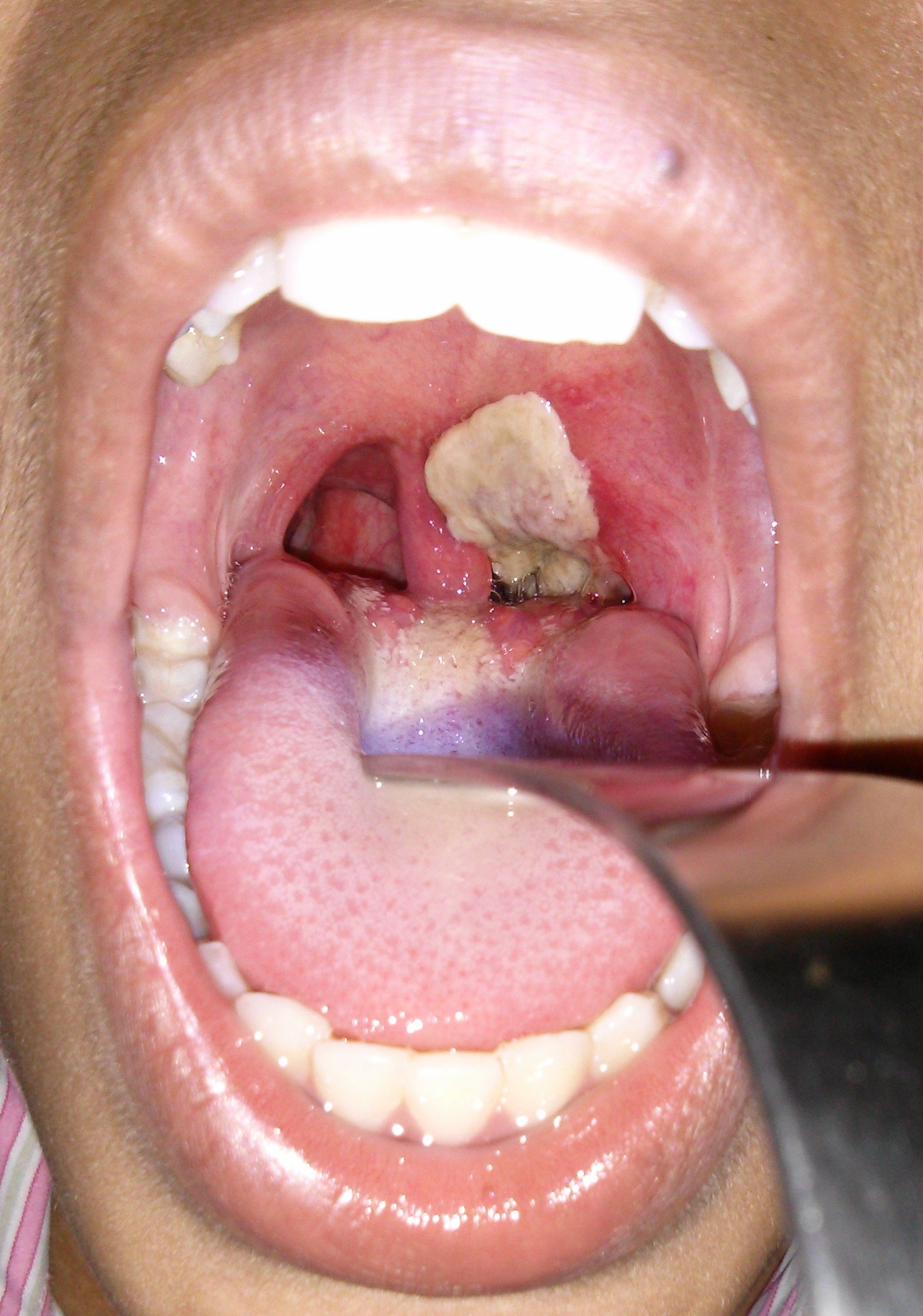 First signs of the infection appear at the back of the throat as a build-up of tough dead cells