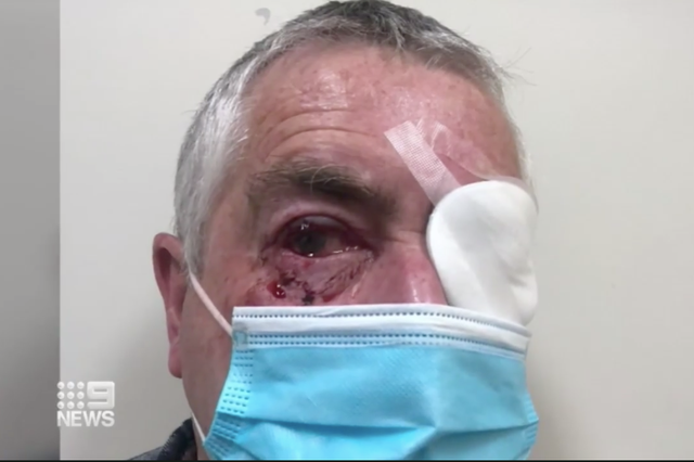 Australian man undergoes eye surgery after attack by magpie
