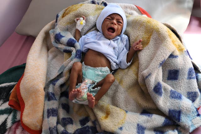 A malnourished child cries at the malnutrition treatment ward of al-Sabeen hospital in Sanaa, Yemen October 27, 2020. REUTERS/Khaled Abdullah