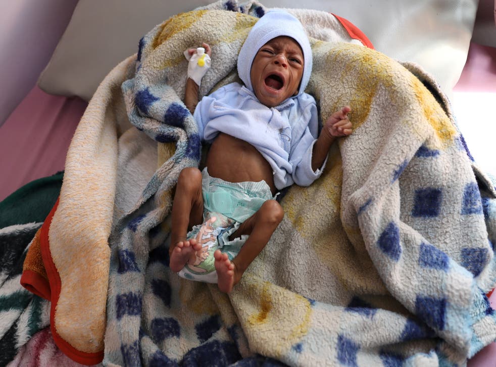 A malnourished child cries at the malnutrition treatment ward of al-Sabeen hospital in Sanaa, Yemen October 27, 2020. REUTERS/Khaled Abdullah