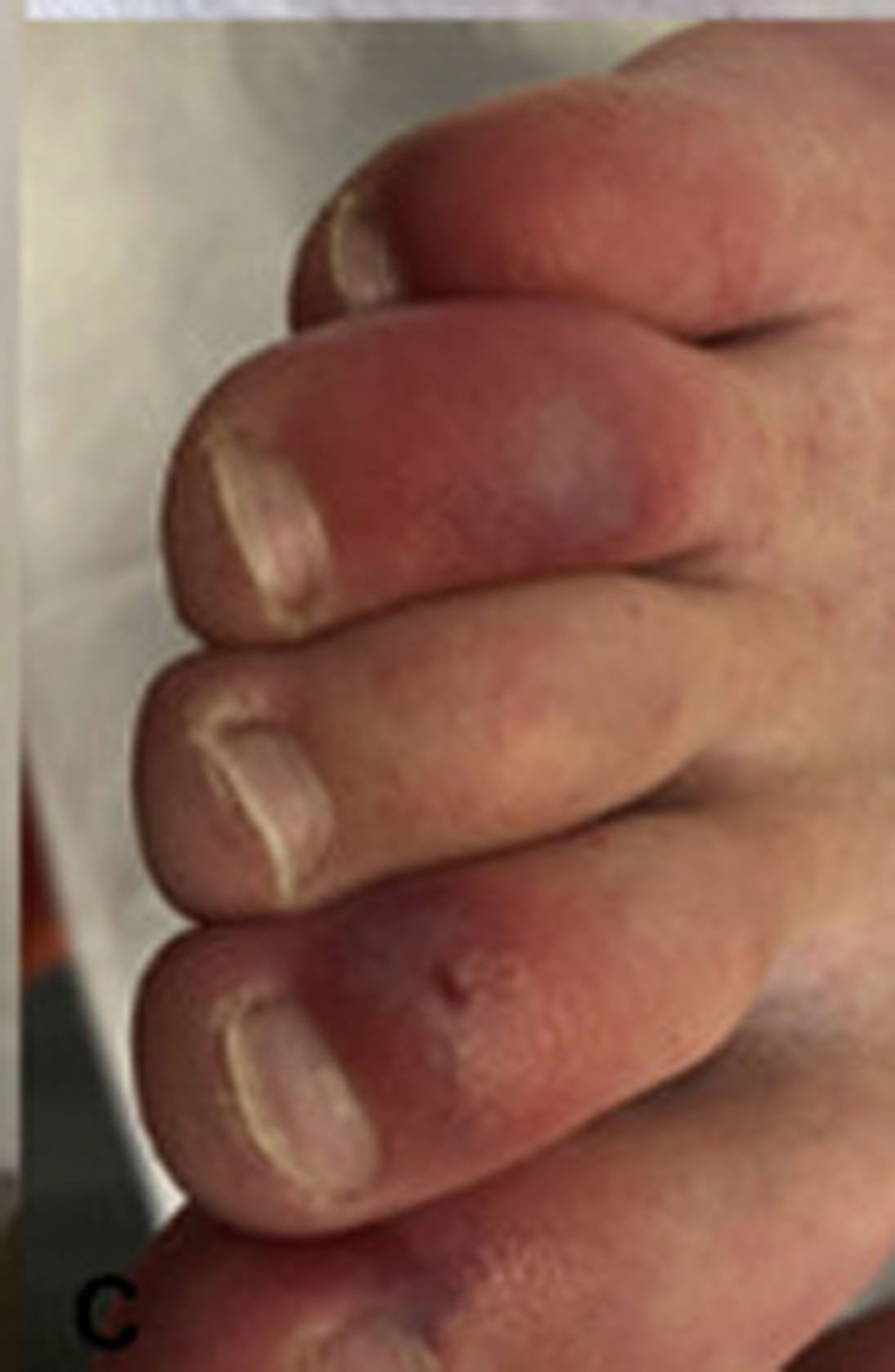 Covid-toe – swollen toes as a result of coronavirus