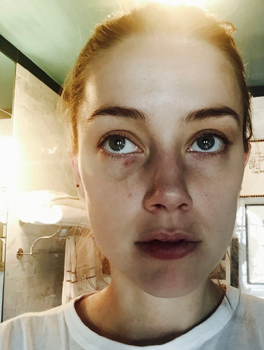 Photo shown in court of injuries Amber Heard sustained during an incident in which Johnny Depp admitted to ‘accidentally’ headbutting her