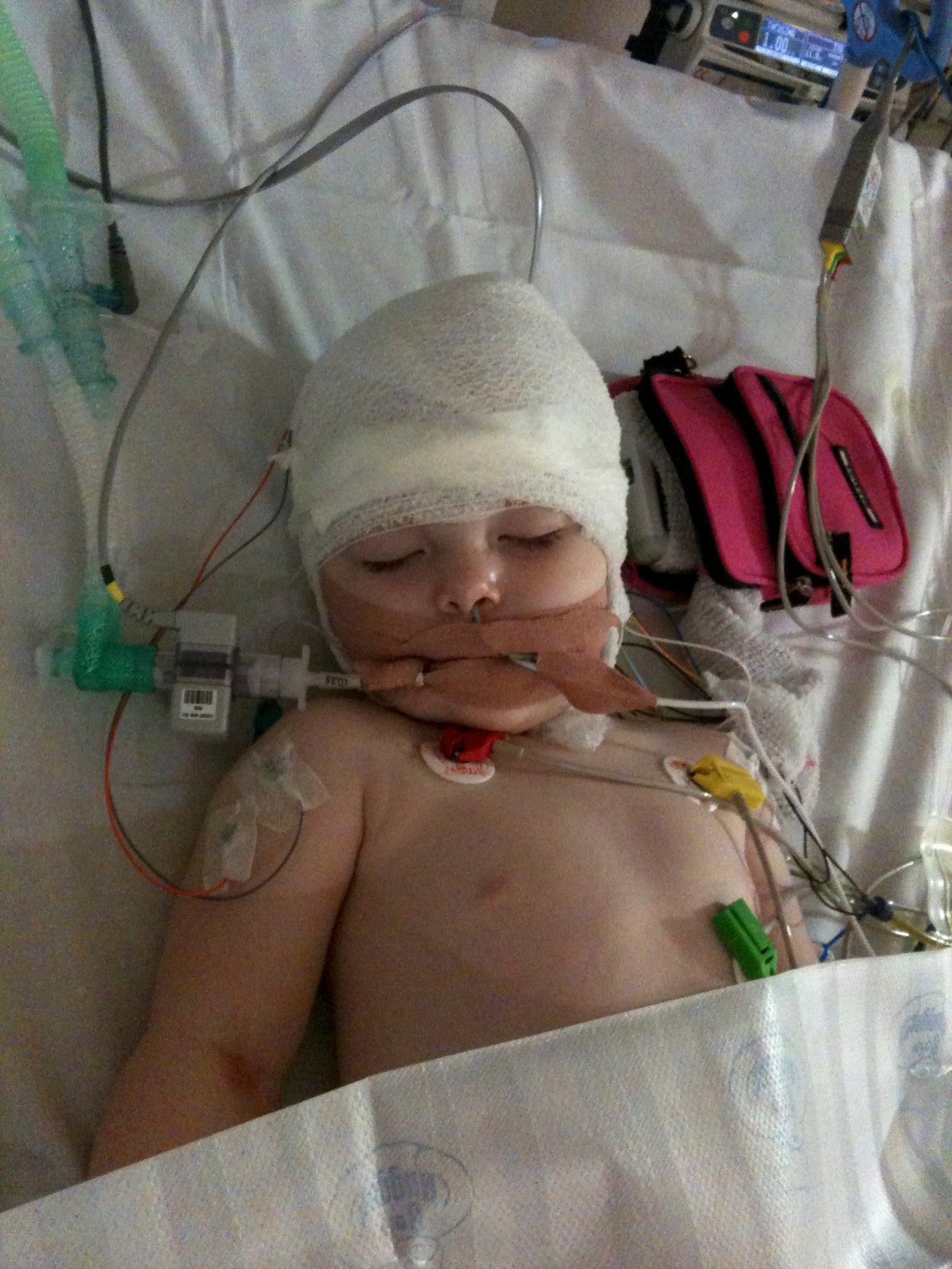 Jasmine Hughes in intensive care at Great Ormond Street Hospital in February 2011