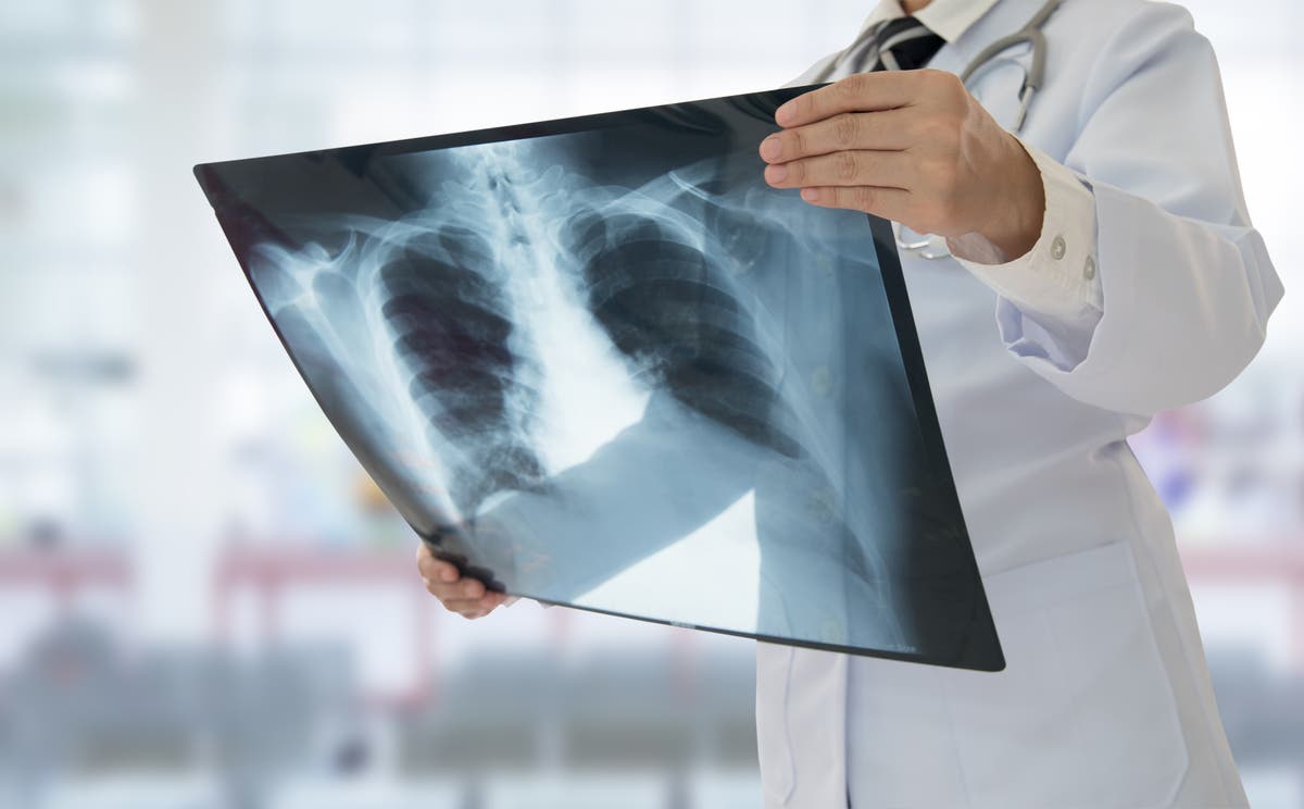 Covid could be causing long-term lung damage, study suggests | The ...