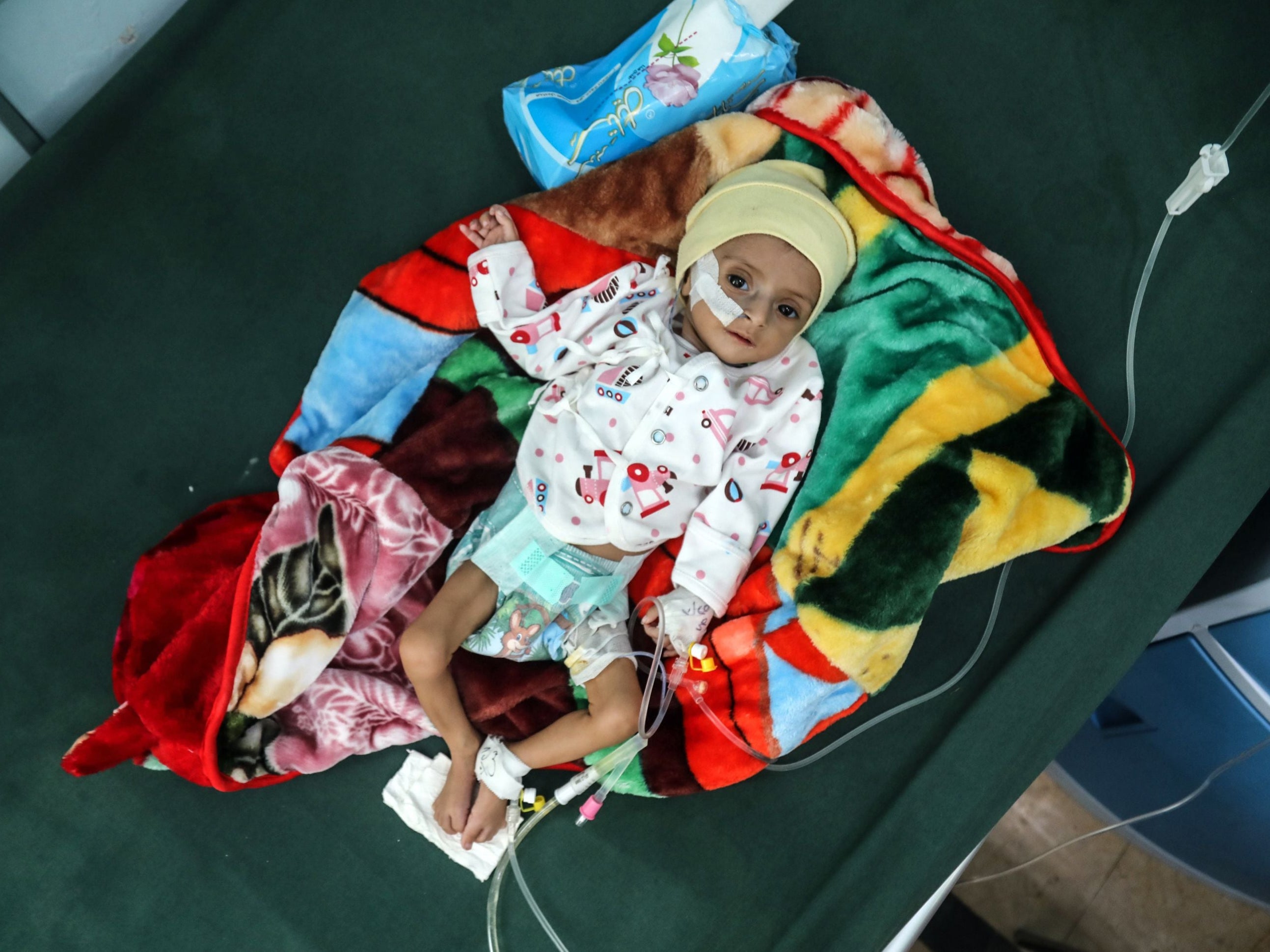 A Yemeni child suffering from malnutrition receives at a treatment centre in Taiz