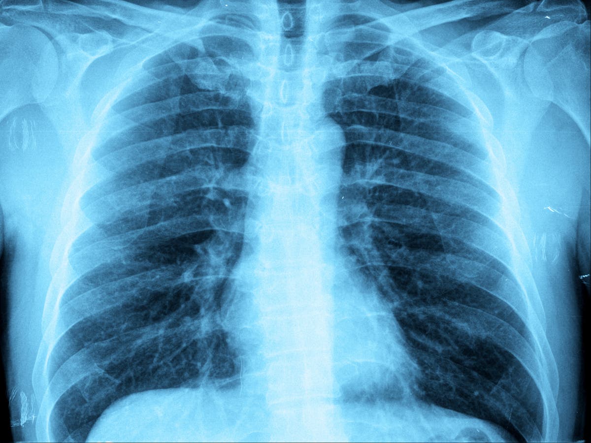 Mysterious ‘white lung pneumonia’ is impacting kids. Right here’s what it is advisable know