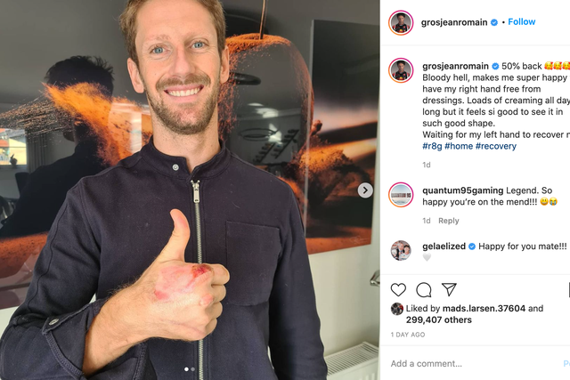 Romain Grosjean revealed the burns suffered to his right hand after having his dressing bandages removed