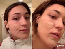 TikTok trend sees people using hydrocolloid bandages to treat acne