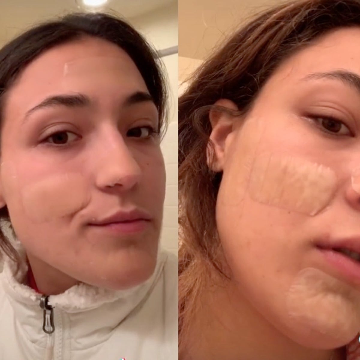 TikTok trend sees people using hydrocolloid bandages to treat acne | The Independent TikTok trend sees people using hydrocolloid bandages to treat acne | The Independent