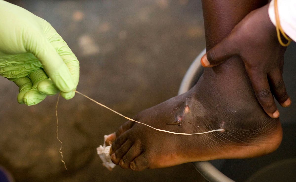 Guinea worm closer to eradication as cases halve in a year People