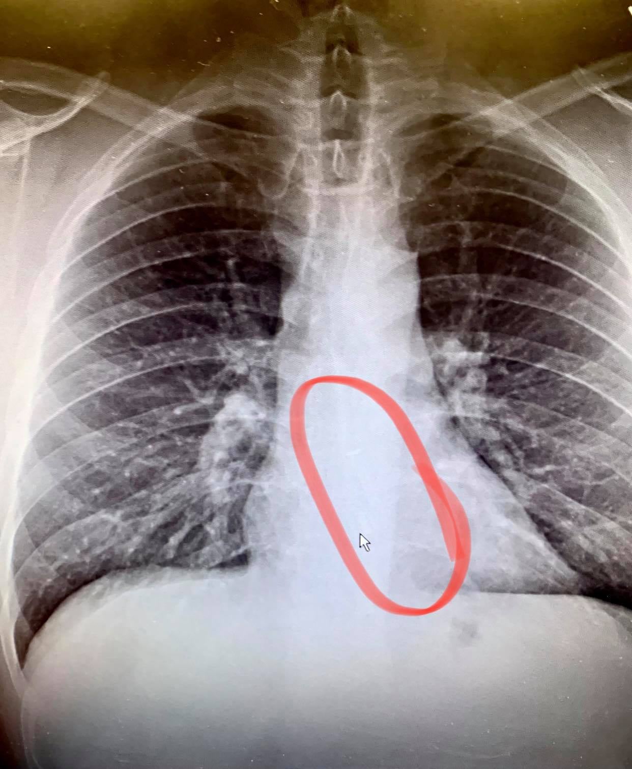 X-rays, pictured from Facebook, showed Brad Gauthier had swallowed an AirPod in his sleep.