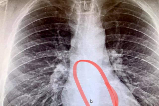 <p>X-rays, pictured from Facebook, showed Brad Gauthier had swallowed an AirPod in his sleep.</p>