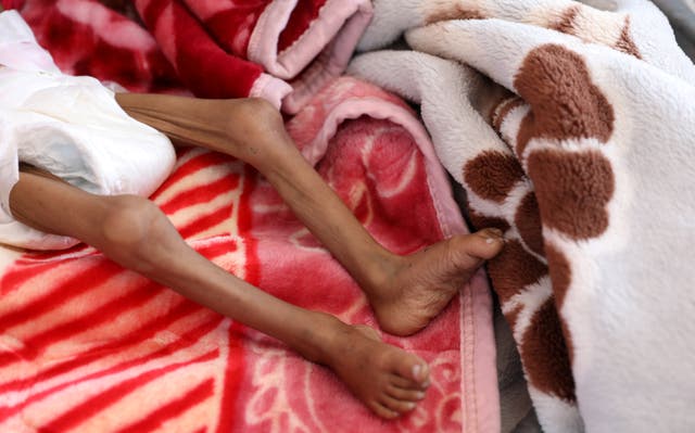 400,000 children in Yemen at risk of dying from hunger, UN warns | The ...