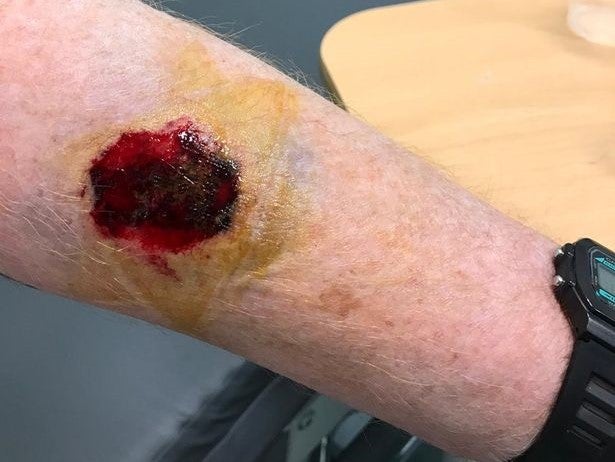 Bite wound to a police officer